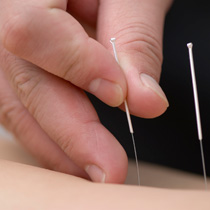 acupuncture